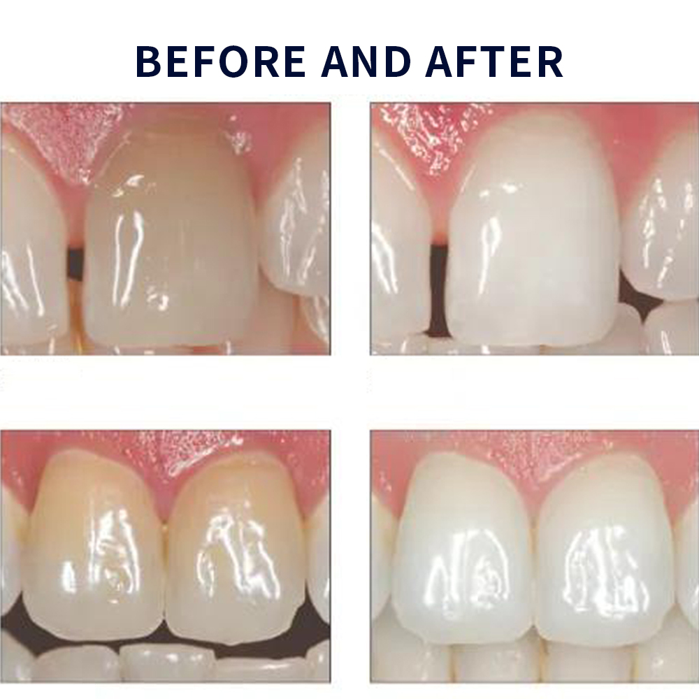 Opalwisdom-Kit de Blanchiment  - Teeth Whitening Price avis et prix