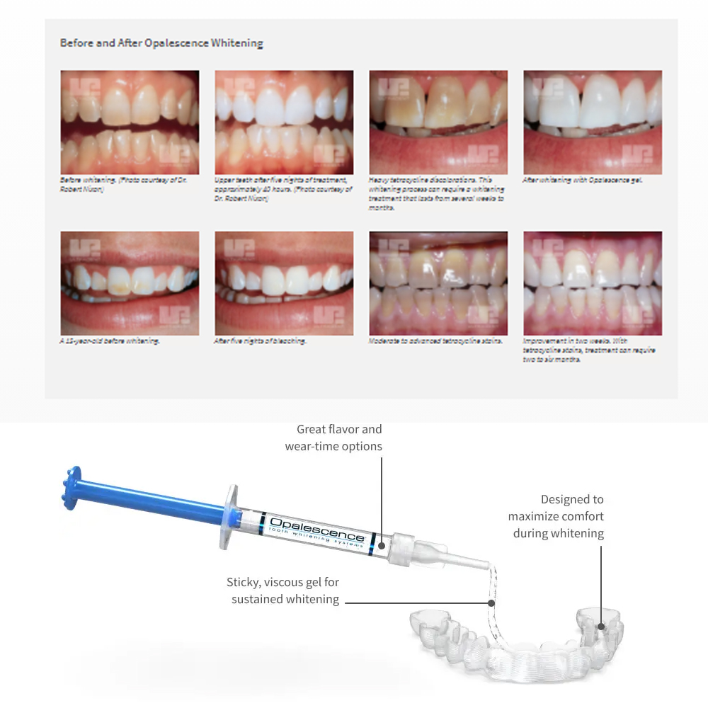 Opalwisdom-Kit de Blanchiment  - Teeth Whitening Price avis et prix