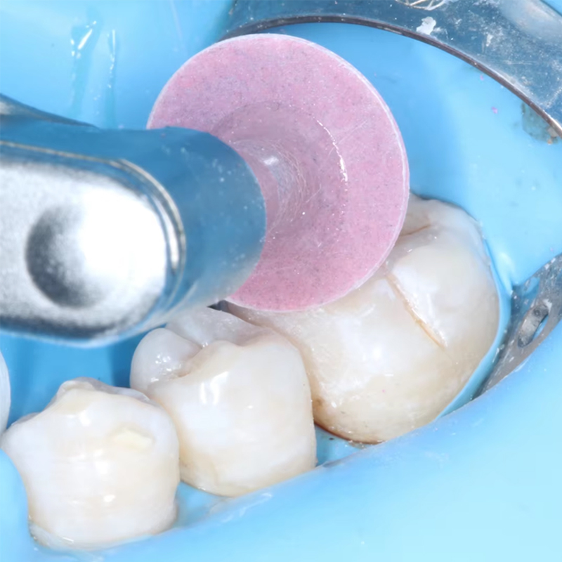 40 disques de polissage dentai - Teeth Whitening Express avis et prix